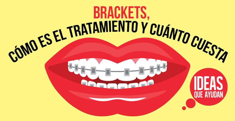 Brackets C Mo Es El Tratamiento Y Cu Nto Cuesta