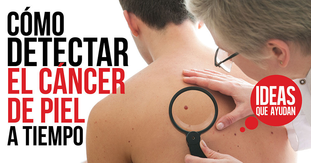 cómo detectar el cáncer de piel a tiempo