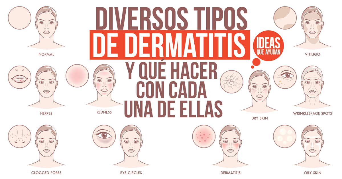 Diversos tipos de dermatitis y qué hacer con cada una de ellas