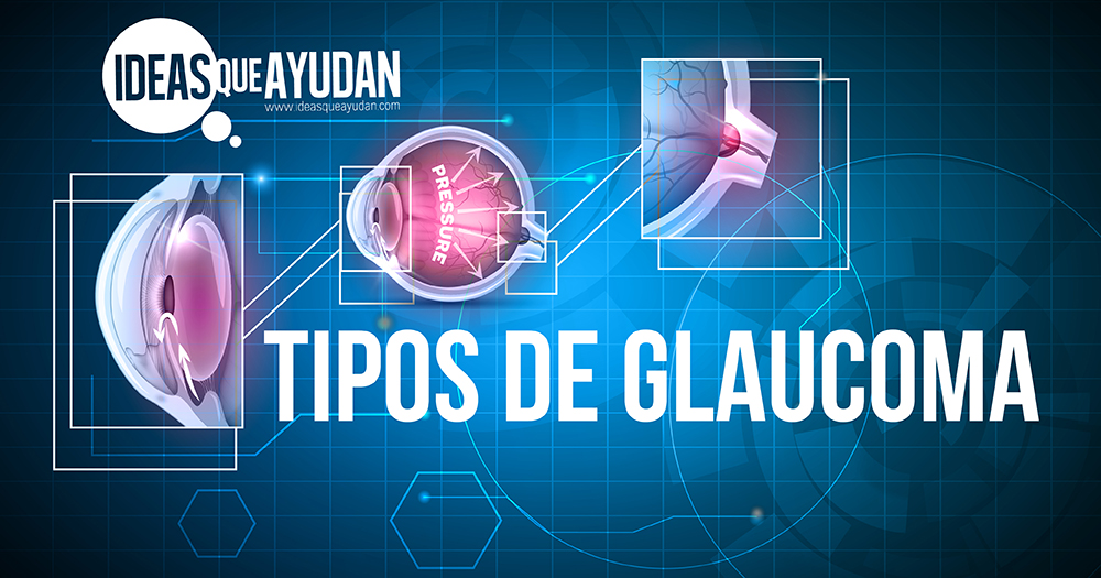 Tipos de glaucoma