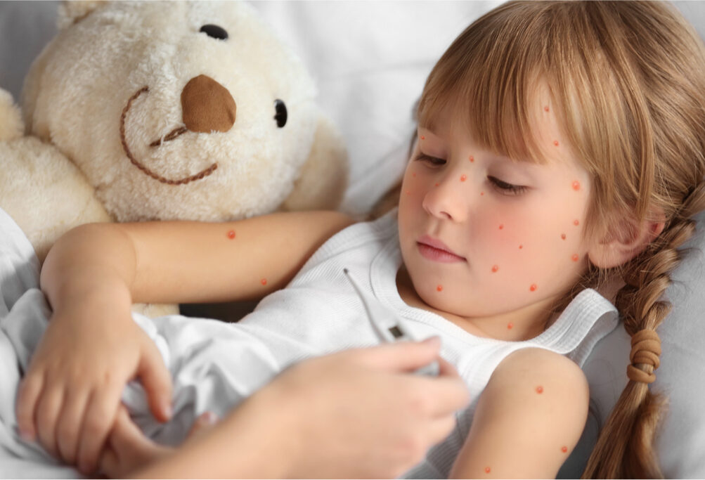 ¿Qué hacer si mi hijo tiene varicela?: Consejos