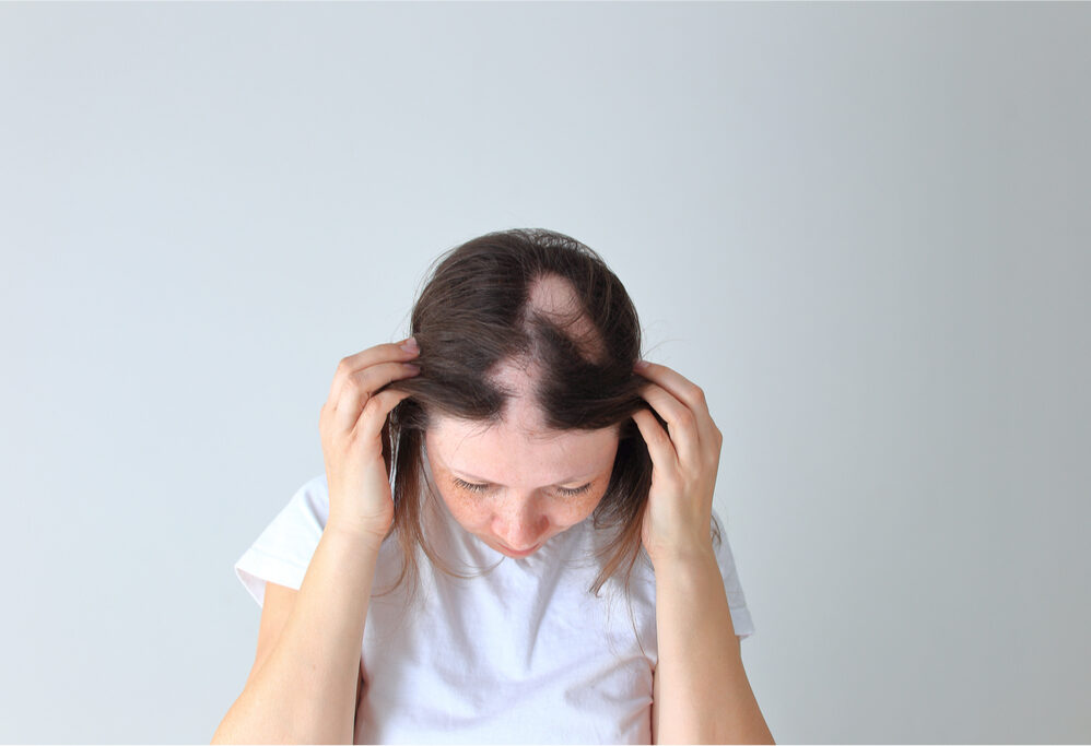 ¡Pierdo mi cabello! ¿Qué es la alopecia y por qué sucede?