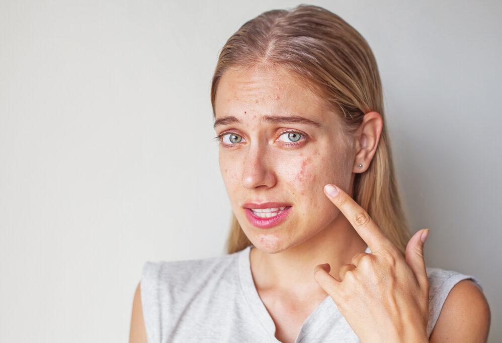 ¿Cómo quitar las manchas de acné?