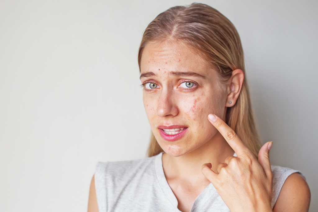 ¿Cómo quitar las manchas de acné?