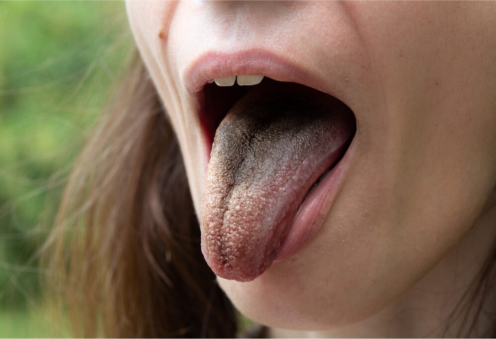 Enfermedad de la lengua vellosa y negra
