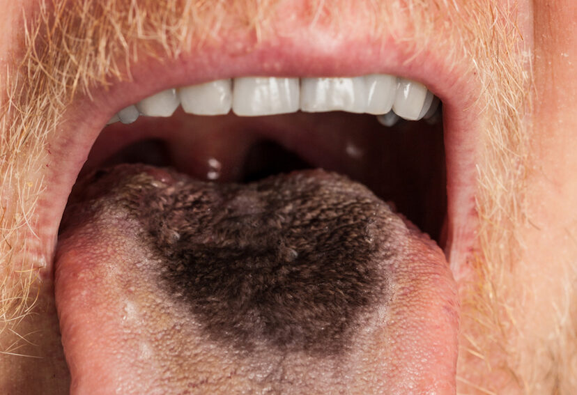 enfermedad de la lengua