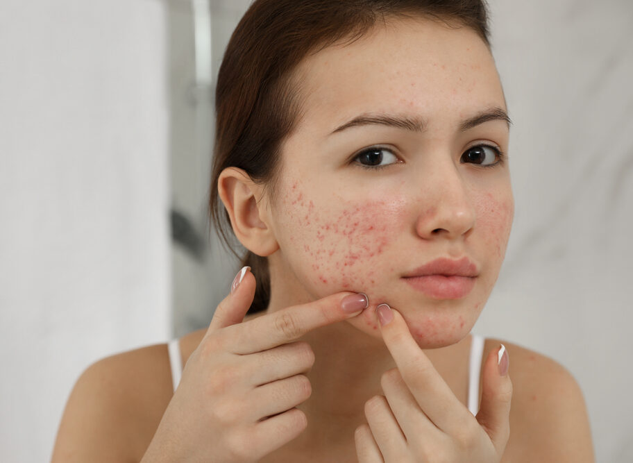 Remedios caseros para combatir el acné