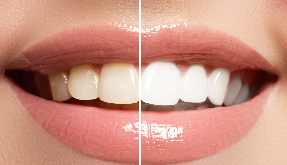 ¿Qué alimentos blanquean los dientes de forma natural?