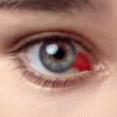 ¿Por qué salen los derrames en el ojo? estas son las posibles causas