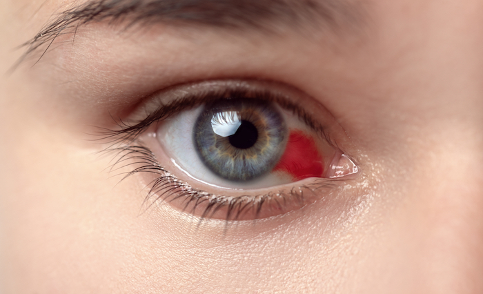 ¿Por qué salen los derrames en el ojo? estas son las posibles causas